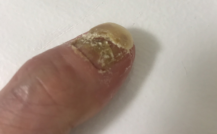 乾癬爪の症状